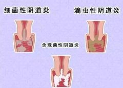 全自动阴道分泌物91视频在线看厂家提醒您还在拖延吗，还在等阴道炎自愈吗？